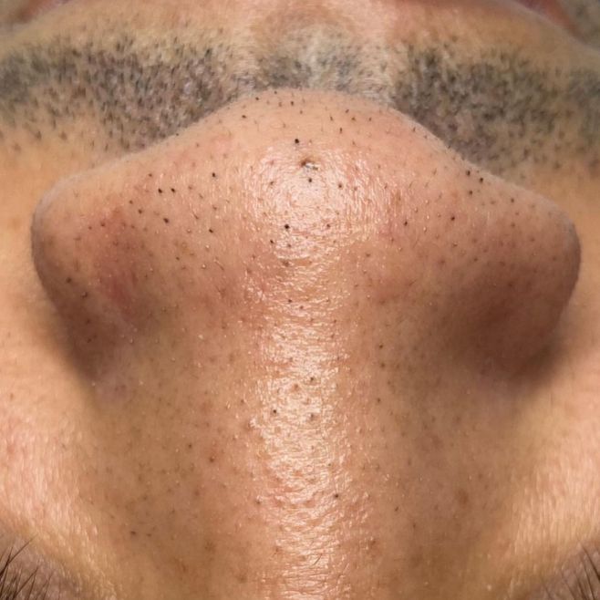 Procedimento de limpeza de pele